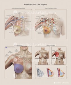 Culley_breast-reconstruction